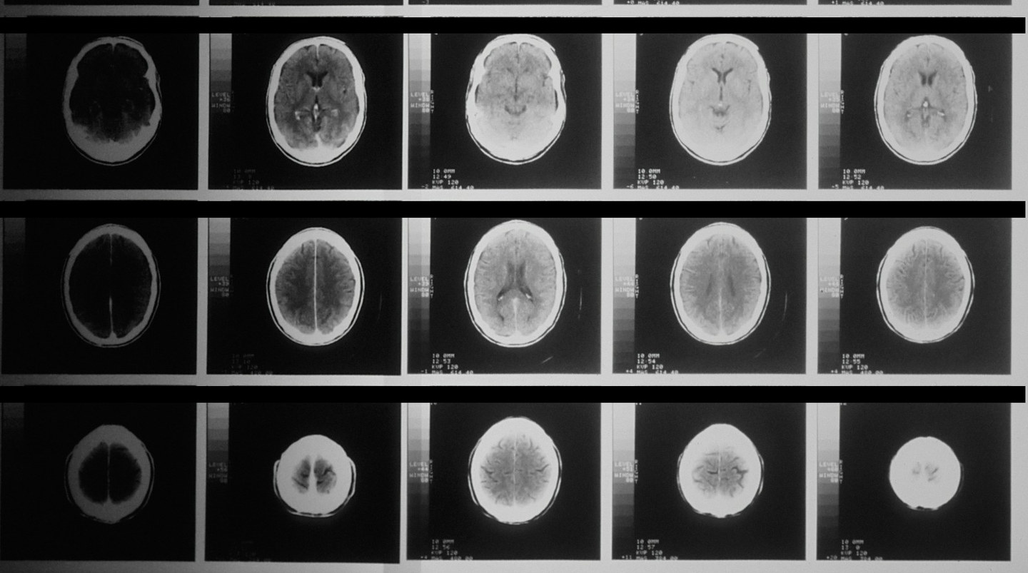 A sheet of brain scan films on a lightbox, fifteen images in three rows. Each is a cross-section through the same head at a different height, the lowest showing the base of the brain and the highest a slice near the top of the skull, so that reading across and down is like moving up through the brain a centimetre at a time