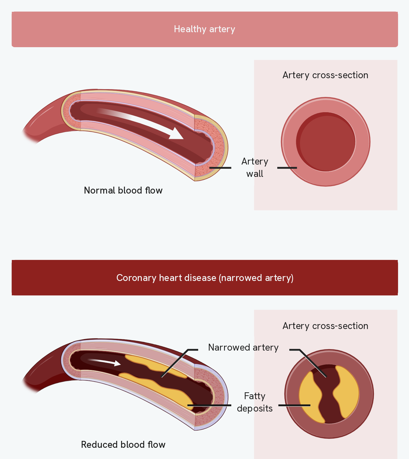 The same coronary artery healthy and diseased, each shown cut along its length and in cross-section. The healthy one has a wide open lumen with blood flowing freely through it. The diseased one has yellow fatty deposits built up inside the wall, pushing into the lumen and leaving a narrow channel, and the labels read narrowed artery and fatty deposits