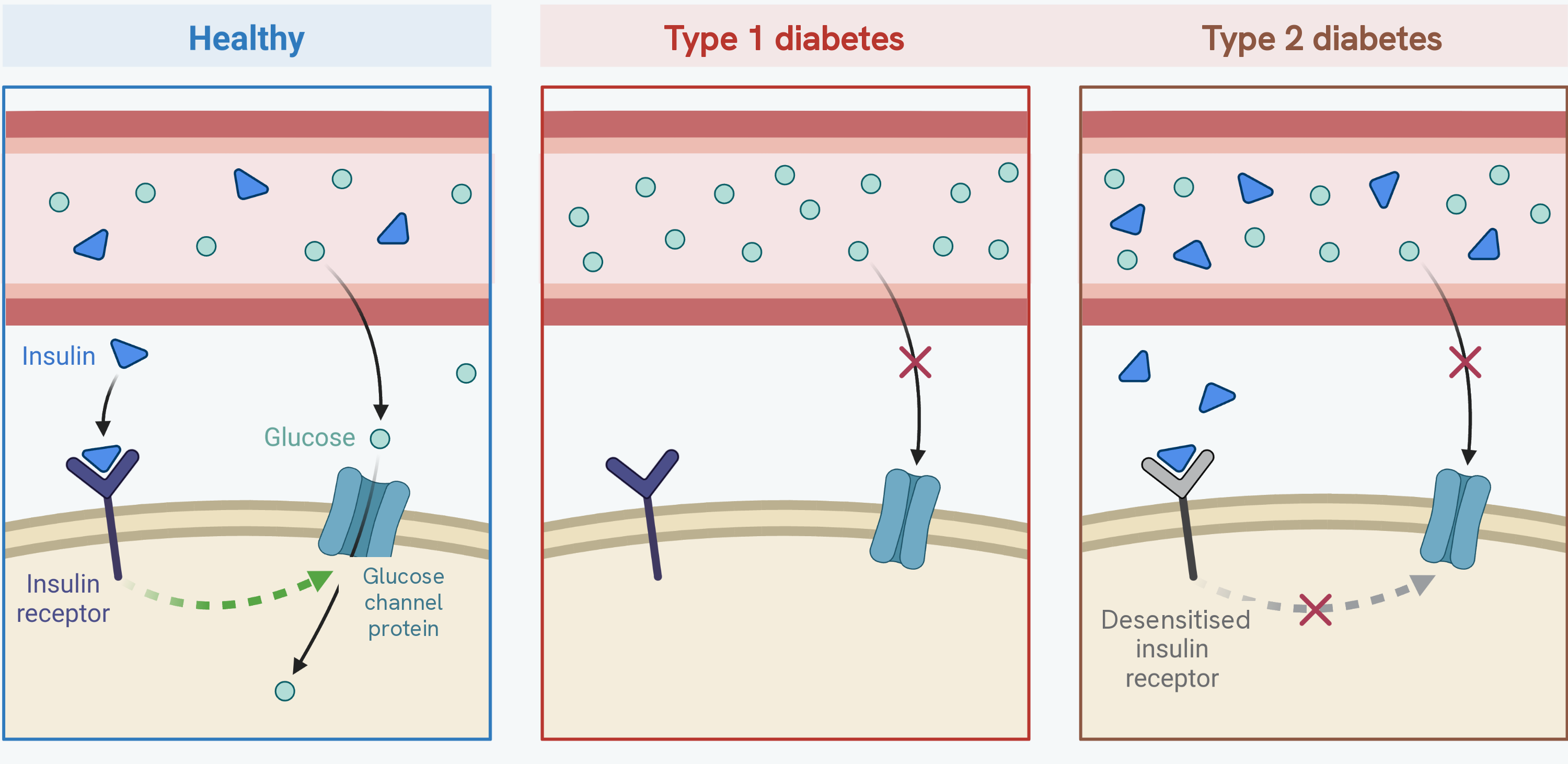 Three panels of the same patch of tissue beside a blood vessel. In the healthy panel, insulin from the blood binds to an insulin receptor on the cell, which signals glucose channel proteins into the membrane, and glucose passes from the blood into the cell. In the type 1 diabetes panel there is no insulin in the blood at all, the receptor is unoccupied and the glucose stays in the blood. In the type 2 diabetes panel there is plenty of insulin and it binds to the receptor, but the receptor is desensitised, the signal to the channel protein is blocked, and the glucose again stays in the blood