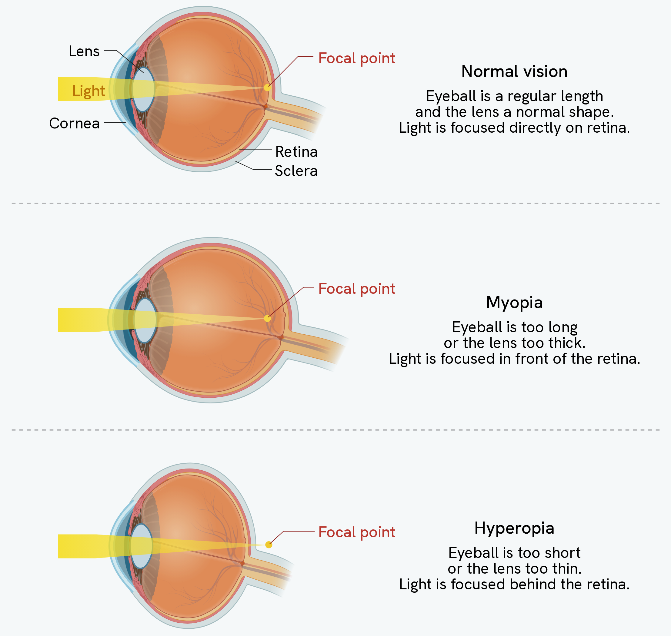 Three eyes compared, each with a beam of light entering from the left. In normal vision the eyeball is a regular length and the lens a normal shape, and the focal point sits exactly on the retina. In myopia the eyeball is too long or the lens too thick, so the focal point falls in front of the retina, inside the eye. In hyperopia the eyeball is too short or the lens too thin, so the focal point falls behind the retina, outside the back of the eye