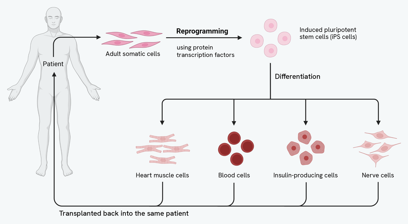The route out of a patient and back again. Adult somatic cells are taken from the patient and reprogrammed, using protein transcription factors, into induced pluripotent stem cells. Those are then differentiated into four kinds of specialised cell: heart muscle cells, blood cells, insulin-producing cells and nerve cells. Arrows carry all four back to the same patient to be transplanted