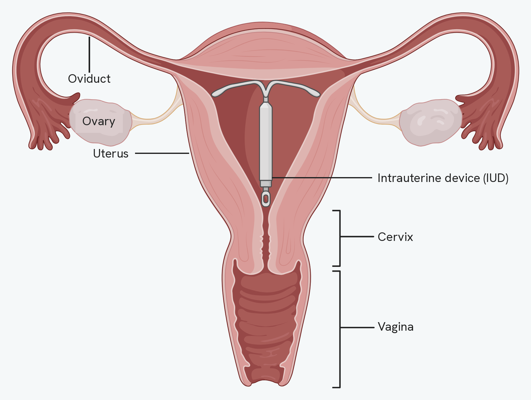 The female reproductive system seen from the front, with an intrauterine device in place. The T-shaped device sits in the cavity of the uterus, its stem pointing down towards the cervix. Labelled around it are the oviduct running from the ovary to the uterus, the ovary at its end, the muscular wall of the uterus, and below the uterus the cervix and then the vagina