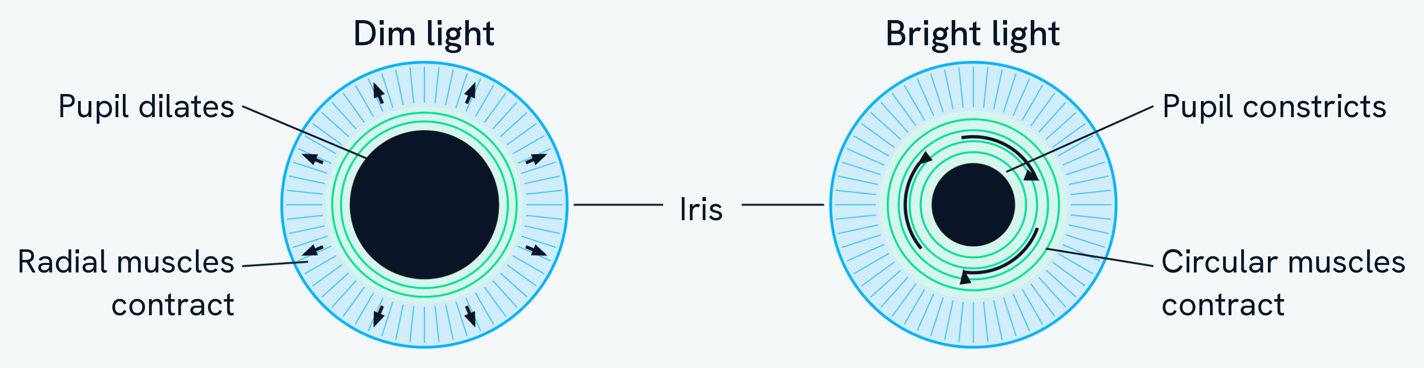 The iris seen from the front in two conditions. In dim light the radial muscles contract, pulling the iris outwards along the spokes, and the pupil is wide. In bright light the circular muscles contract, tightening the ring around the opening, and the pupil is small. The iris is the whole coloured ring of muscle in both