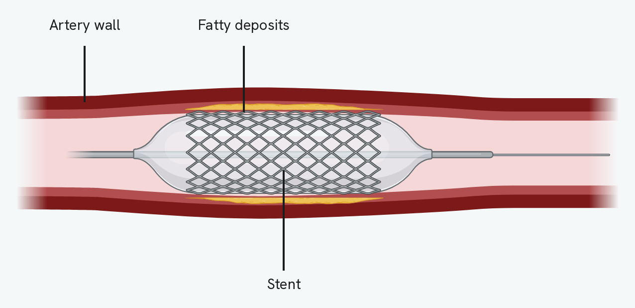 A stent in place inside a narrowed artery, seen from the side. The wire mesh tube has been expanded inside the artery and is pressing the yellow fatty deposits back against the artery wall, leaving a clear channel down the middle. The balloon that opened it is still in place around it, on the fine wire it was carried in on. The labels read artery wall, fatty deposits and stent