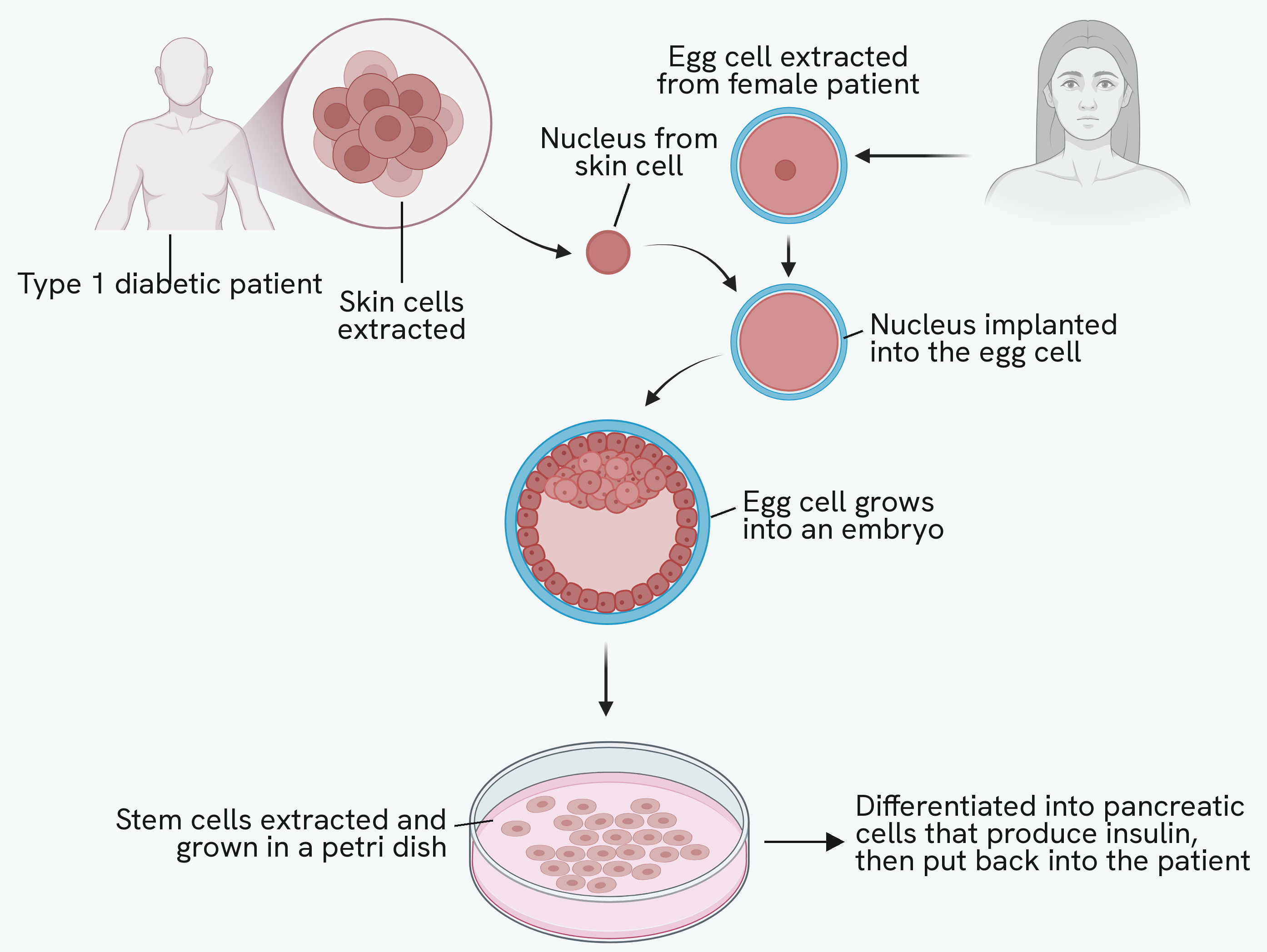 Therapeutic cloning for a patient with type 1 diabetes. Skin cells are taken from the patient and the nucleus of one of them is removed. An egg cell is taken from a female donor and its own nucleus replaced with the patient's skin cell nucleus. The egg cell grows into an embryo, stem cells are taken from it and grown in a petri dish, and those stem cells are made to differentiate into insulin-producing pancreatic cells that are put back into the patient